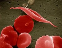 SEM image of sickled and other red blood cells, false coloured red. © E.M.Unit, Royal Free Hospital School of Medicine/Wellcome Trust Photo Library