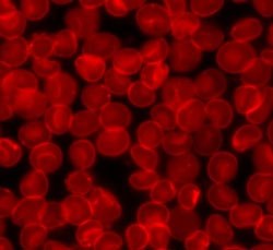 Leukaemia: A reason to hope