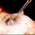 Cataract surgery can restore vision