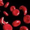 Silent strokes can cause long-term cognitive, learning deficits in children with sickle cell disease