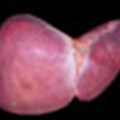 New strides in identifying and improving screening practices and treatment for liver-related disease