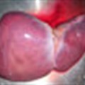 Hepatitis C virus (HCV)-associated liver disease after liver transplantation