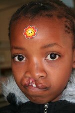 Michelle Abrahams before surgery.