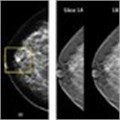 Detecting breast cancer: 3-D screening reduces recall rates