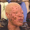 People with albinism call for recognition
