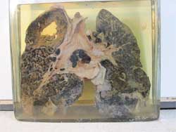 A mineworker's lungs infected with silicosis and tuberculosis. Image: Wiki Images