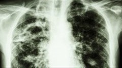 Reducing TB in HIV patients through two-pronged approach