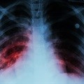 Blocking TB vitamin production may be key to treatment