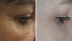 An about face about non-invasive plasma soft surgery