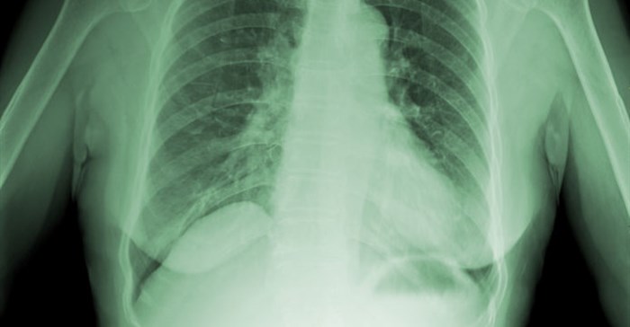 Positive results from TB and HIV/Aids prisons programme