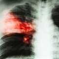Groundbreaking settlement in silicosis/TB class action