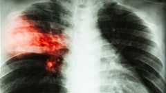 Groundbreaking settlement in silicosis/TB class action