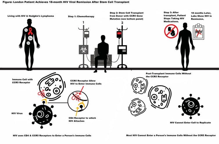 Top panel illustrates the treatment course for the London patient. Step 1: Chemotherapy; Step 2: The patient received a stem cell transplant from a donor with a genetic mutation in the CCR5 receptor gene; Step 3: Sixteen months after the patient’s transplant, HIV medications were interrupted. Patient is in HIV remission 18 months later. Lower left panel shows the target for HIV, the CD4+ T-cell. Most HIV uses both the CD4 and CCR5 receptor to enter a person’s immune cells. Lower right panel show
