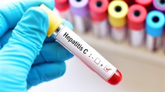 Hepatitis is a major public health burden. Shutterstock