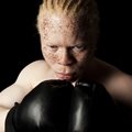 UN expert to assess SA's rights of people with albinism