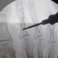 Giant strides forward in minimally invasive foot surgery
