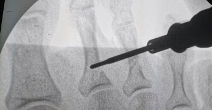 Giant strides forward in minimally invasive foot surgery