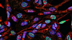 Tumour cells under a microscope labelled with fluorescent molecules. Shutterstock