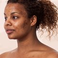 Different types of pigmentation and how to treat it