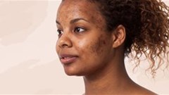 Different types of pigmentation and how to treat it
