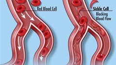 Normal blood cells (left) and the blood cells in sickle cell disease, which do not flow through the circulatory system smoothly. Credit: Darryl Leja, NHGRI (CC BY 2.0)