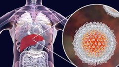 Abbott seeks new treatment standards for Africa's silent killer disease