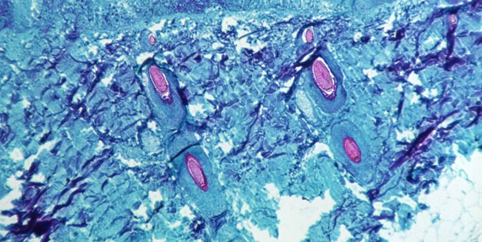 Source: Supplied. A section of skin tissue, harvested from a lesion on the skin of a monkey, that had been infected with monkeypox virus, is seen at 50X magnification on day four of rash development in 1968. CDC/Handout via REUTERS