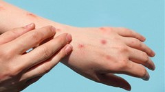 Source: National Institute for Communicable Diseases.