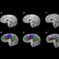 Image supplied. Diffusion tensor imaging shows corpus callosum fibre tracts in two adolescents: One with traumatic brain injury (TBI; G and H) and one with an orthopaedic injury (E and F). At 3 months post-injury (E, G), early degeneration and loss of fibre tracts are visible, especially in the TBI case. At 18 months (F, H), some recovery or reorganisation occurs, but persistent loss and thinning of tracts remain, particularly in the frontal regions, indicating lasting white matter damage after TBI.