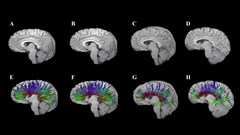 Image supplied. Diffusion tensor imaging shows corpus callosum fibre tracts in two adolescents: One with traumatic brain injury (TBI; G and H) and one with an orthopaedic injury (E and F). At 3 months post-injury (E, G), early degeneration and loss of fibre tracts are visible, especially in the TBI case. At 18 months (F, H), some recovery or reorganisation occurs, but persistent loss and thinning of tracts remain, particularly in the frontal regions, indicating lasting white matter damage after TBI.