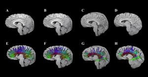 Image supplied. Diffusion tensor imaging shows corpus callosum fibre tracts in two adolescents: One with traumatic brain injury (TBI; G and H) and one with an orthopaedic injury (E and F). At 3 months post-injury (E, G), early degeneration and loss of fibre tracts are visible, especially in the TBI case. At 18 months (F, H), some recovery or reorganisation occurs, but persistent loss and thinning of tracts remain, particularly in the frontal regions, indicating lasting white matter damage after TBI.