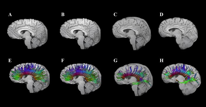 Image supplied. Diffusion tensor imaging shows corpus callosum fibre tracts in two adolescents: One with traumatic brain injury (TBI; G and H) and one with an orthopaedic injury (E and F). At 3 months post-injury (E, G), early degeneration and loss of fibre tracts are visible, especially in the TBI case. At 18 months (F, H), some recovery or reorganisation occurs, but persistent loss and thinning of tracts remain, particularly in the frontal regions, indicating lasting white matter damage after TBI.